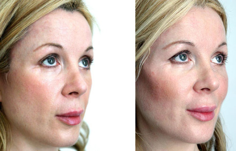 Метод хирургической коррекции скул