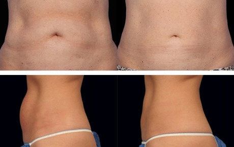 Криолиполиз на аппарате «Zeltiq»: до и после