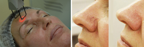 Преимущества лазерной терапии купероза лица Преимущества лазерной терапии купероза лица