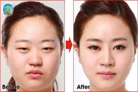 Пластика азиатских глаз