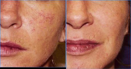 Лазерное лечение купероза