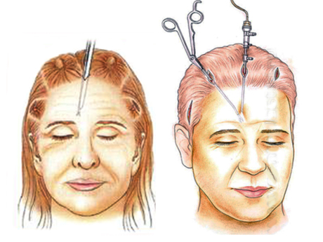 Фейслифтинг эндоскопический