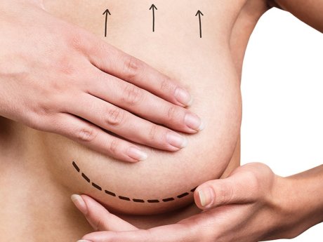 Подтяжка груди (мастопексия)