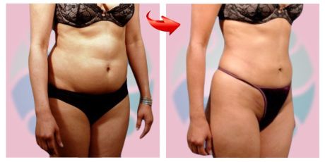 Липосакция - до и после