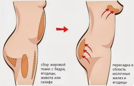 Липофилинг - проведение процедуры