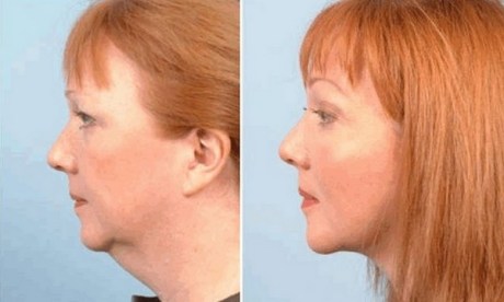 коррекция подбородка до и после