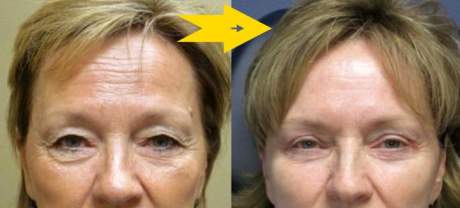 Эндоскопический лифтинг - возможности методики