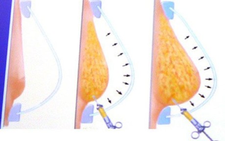 Коррекция размеров груди при помощи липофилинга