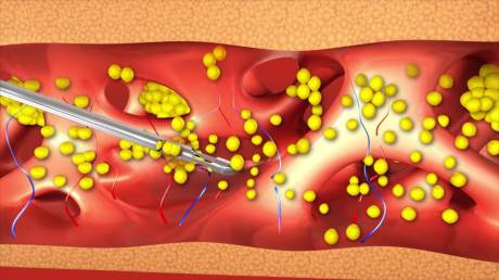 Особенности проведения Water-assisted liposuction