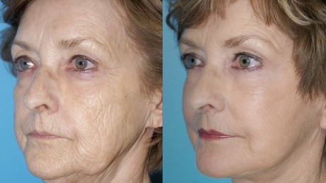 Плазмолифтинг: до и после