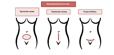 Миниабдоминопластика