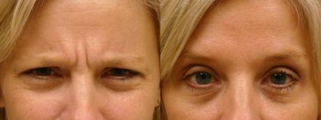 Коррекция межбровных морщин