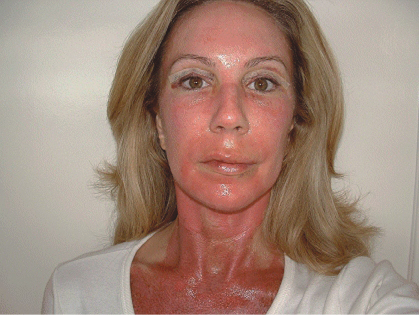 Осложнения после пилинга