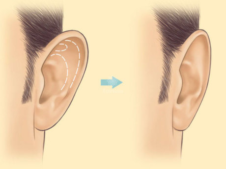 Пластика ушных раковин