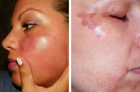 Осложнения после пилинга