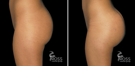липофилинг ягодиц: до и после
