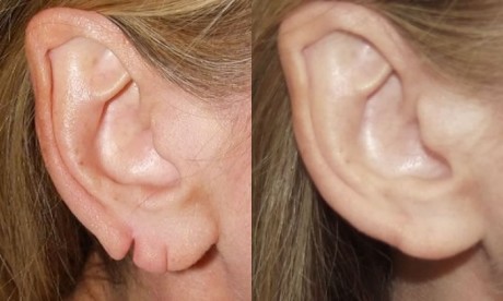 Пластика для мочек ушных раковин до и после