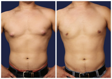 Гинекомастия у мужчин