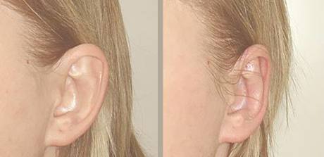 Ушные корректоры: до и после