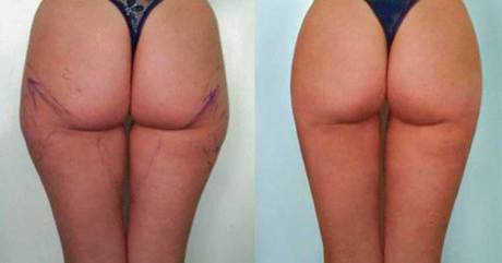 Пластика бедер - после операции