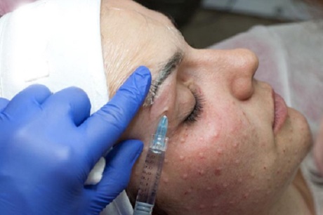 Папулы после биоревитализации и мезотерапии