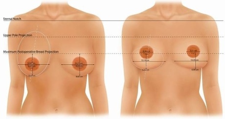 Подтяжка груди (мастопексия)