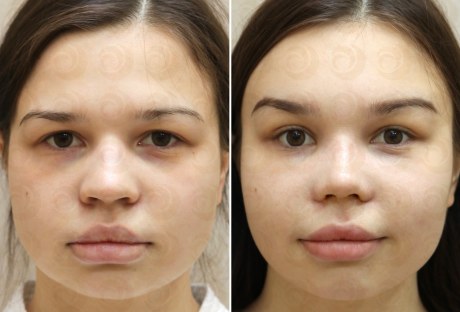 Лифтинг бровей и лба: до и после