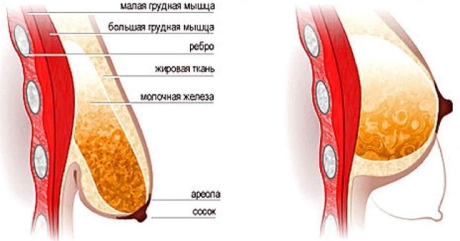 Пластика по подтяжке грудей - особенности процедуры