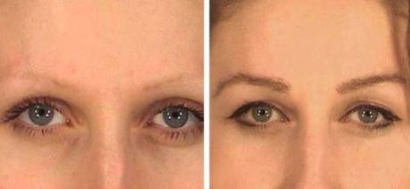 Пересадка бровей - до и после