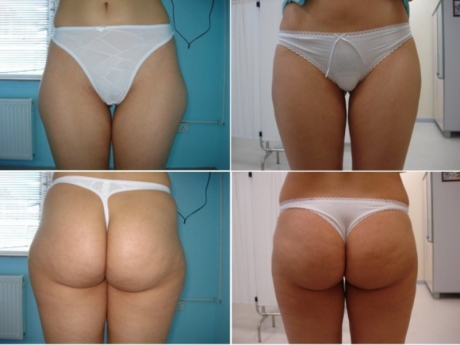 Липофилинг - до и после