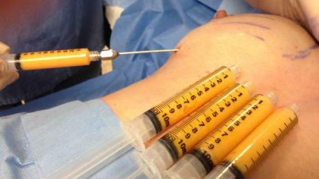 Коррекция размеров груди при помощи липофилинга