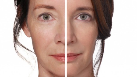 Радиесс - гель для контурной пластики с оптимальными свойствами