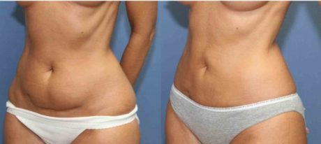 Безоперационная липосакция