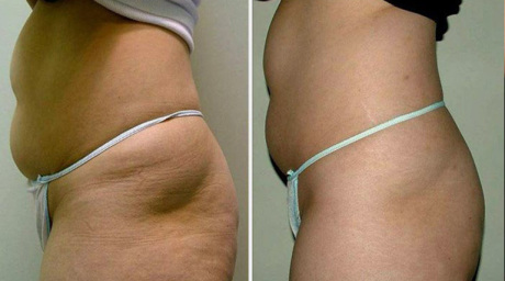 Ультразвуковая липосакция - кавитация: до и после