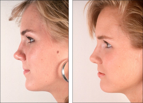 ринопластика