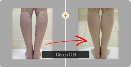 Пластика для коррекции голеней - до и после Пластика для коррекции голеней - до и после