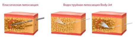 Водоструйная липосакция