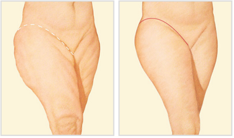 Виды операций по подтяжке бедер