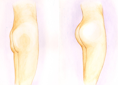 Процедура липофилинга для коррекции ягодиц
