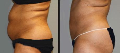 Водоструйная липосакция: до и после