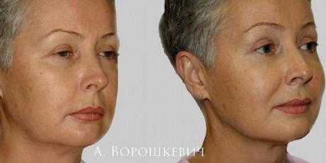 Фейслифтинг эндоскопический: до и после