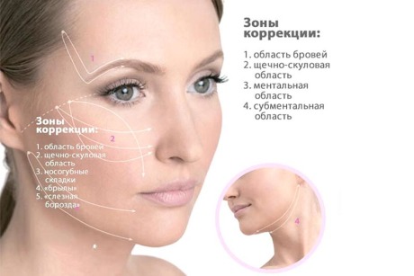 Виды нитей для лифтинга