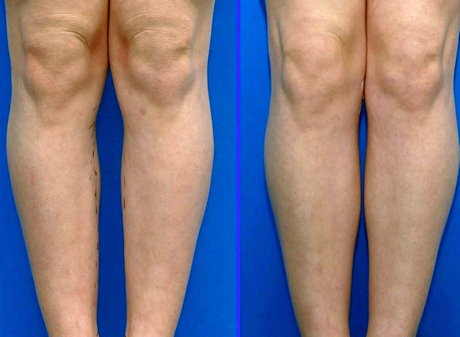 Пластика для коррекции голеней