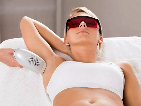 Лазерная эпиляция