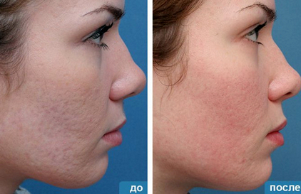 Озонотерапия: до и после