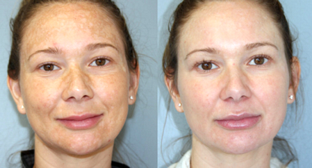 Дермахил: до и после процедуры