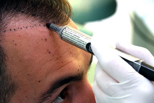 Трансплантация волос