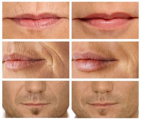 Reneall - линейка гиалуроновых монофазных филлеров отечественного производства