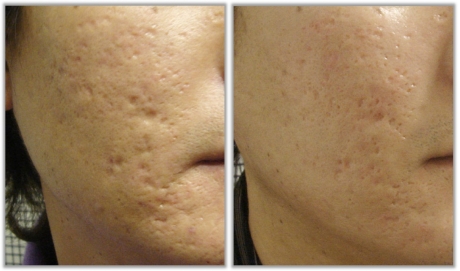 Дермабразия все о ней