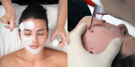 Лазерная чистка лица